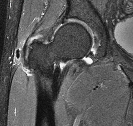 Figure 2 for case Gluteus minimus calcific tendinitis